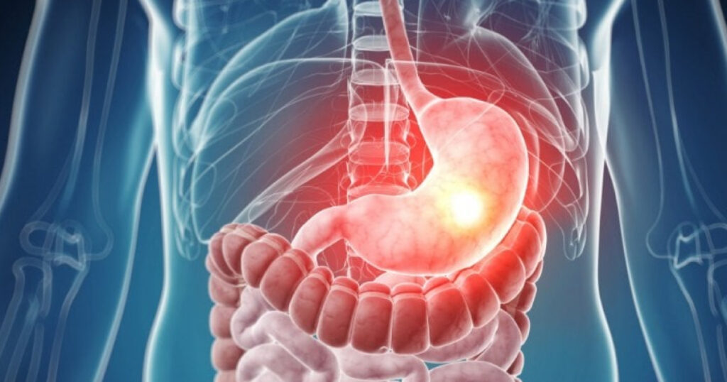 Motilite Bozuklukları