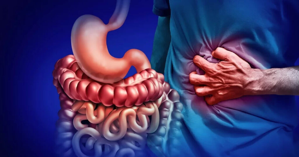 Crohn Hastalığı Nedir?