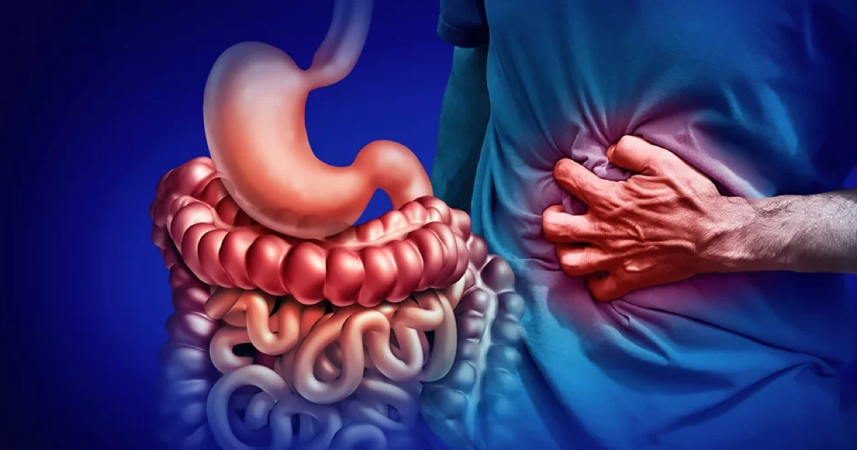 Crohn Hastalığı Nedir?