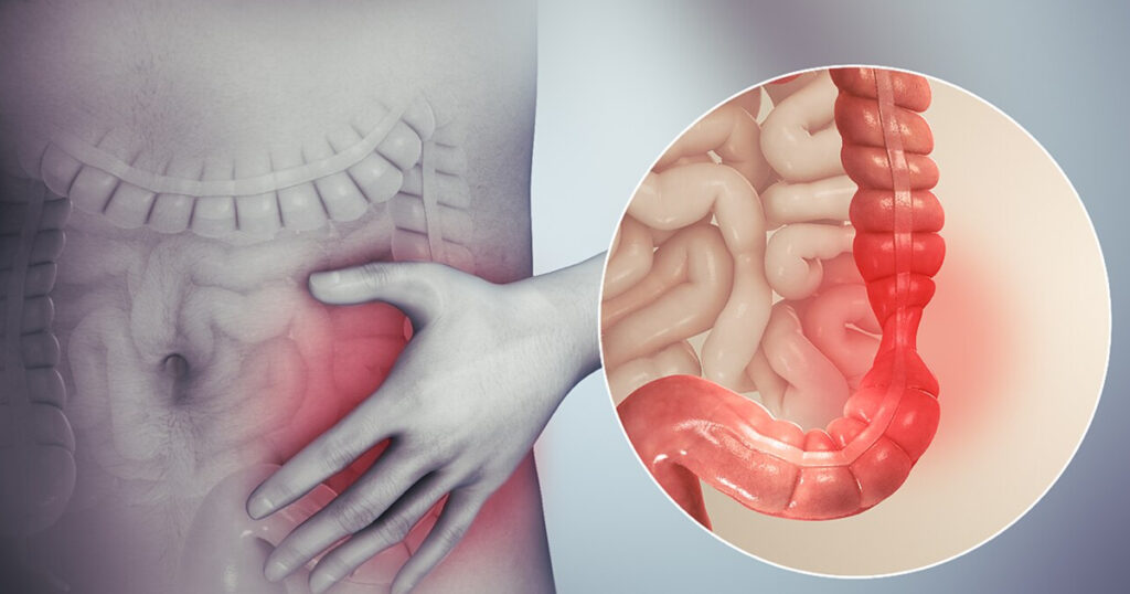 İrritabl Bağırsak Sendromu (İBS)
